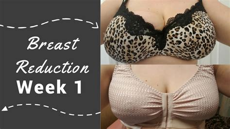 Breast Reduction Week 1 Post Op Chat Youtube