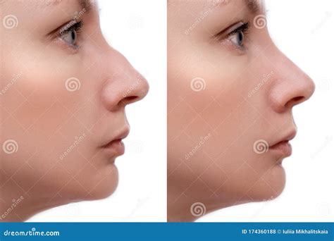 Young Woman Before And After Rhinoplasty And Nose Hump Shape