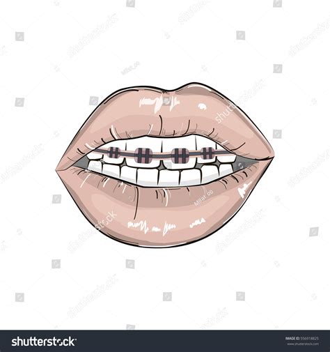 Vektor Stok Sexy Lips Braces Illustration Erotic Playful Tanpa Royalti