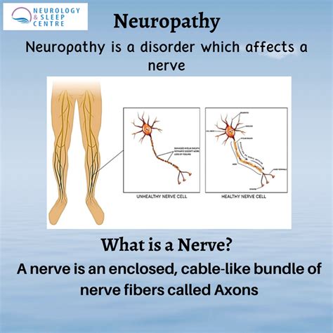 Neuropathy Causes Symptoms Diagnosis And Treatment Neurology And Sleep