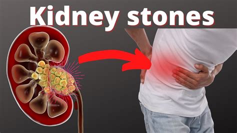 How Long Does It Take To Pass A Kidney Stone From The Ureter Youtube