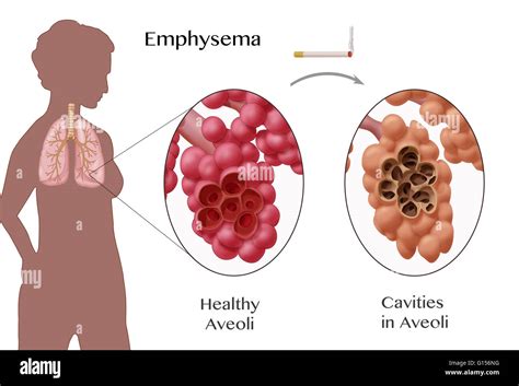 Illustration Depicting Emphysema A Condition Characterized By Damage
