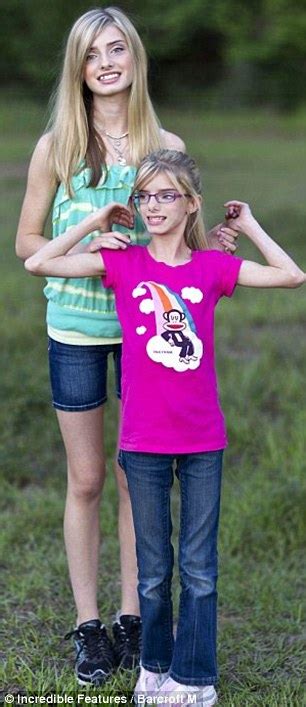 Teen Born With Primordial Dwarfisms Identical Twin Helps Her Navigate