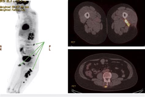 Imaging Depicts Multiple Subcutaneous Soft Tissue Nodules Noted In The