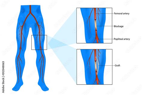 Femoral Popliteal Also Called Femoropopliteal Or Fem Pop Bypass