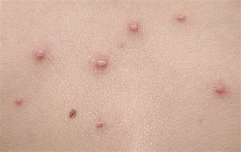 Pin On Health Skin Allergyeczema