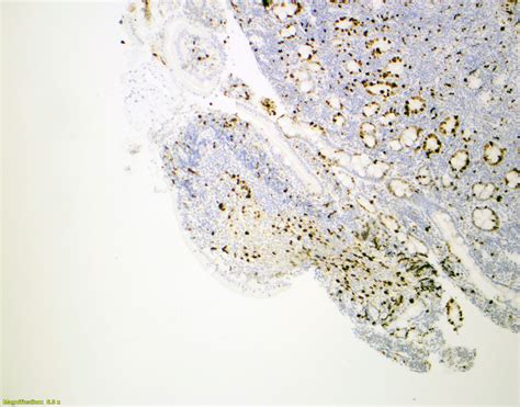 Pathology Outlines Follicular Lymphoma Duodenal Type