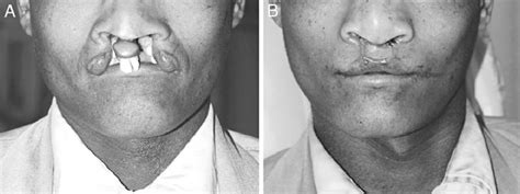 Cleft Lip And Palate Adult