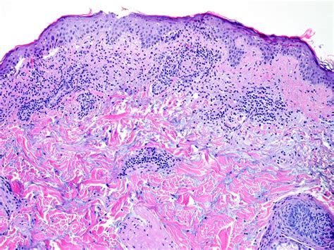 Subacute Cutaneous Lupus Erythematosus With A Possible Paraneoplastic