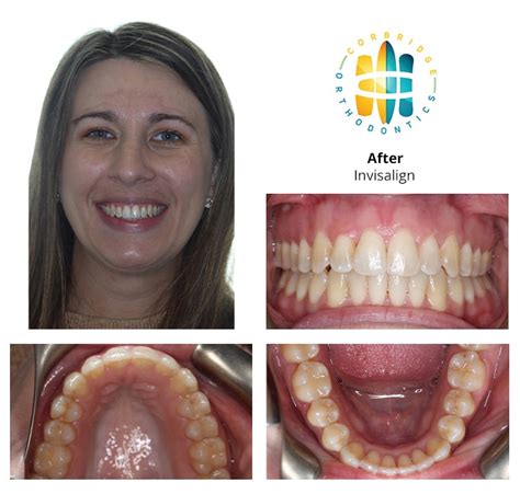 Before And After Orthodontic Treatment Corbridge Orthodontics