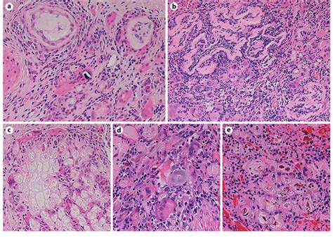 Key message granulation tissue formation is one of the late complications of tracheostomy. High-power histologic views of the "pulse granuloma ...