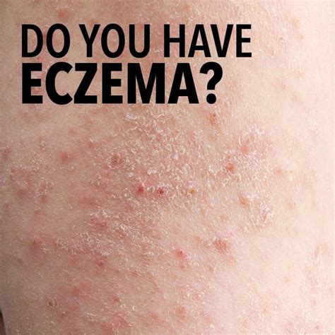 If You Have Dry Itchy And Rough Skin You May Have Eczema Dry Itchy