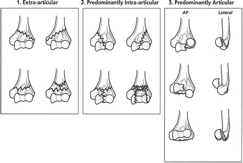 A Clinically Applicable Fracture Classification For Distal Humeral My