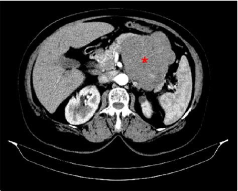 A Pre Operative Ct Scan Showing A Large Lobulated Poorly Enhancing