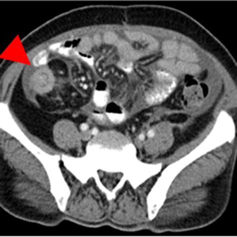 Sagittal Section Of The Abdominal Ct Scan Showing An Entrapped Bowel