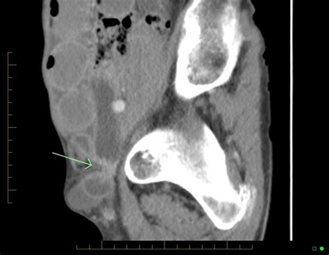 Femoral Hernia Anatomy