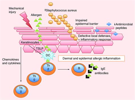 Overview Of The Pathogenesis Of Acute Lesions Of Atopic Dermatitis