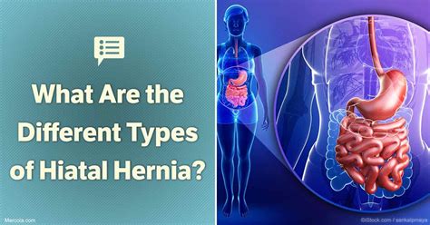 What Are The Different Types Of Hiatal Hernia