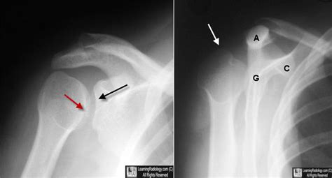 Learning Radiology Dislocation Shoulder Posterior