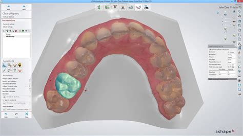 3shape Clear Aligner Studio Teeth Movement In Virtual Setup Br Pt