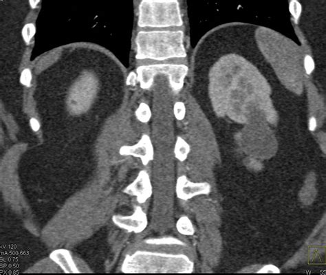 Bosniak Ii Cyst Kidney Case Studies Ctisus Ct Scanning