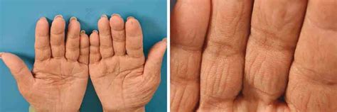 Tripe Palms Causes Symptoms Diagnosis And Treatment