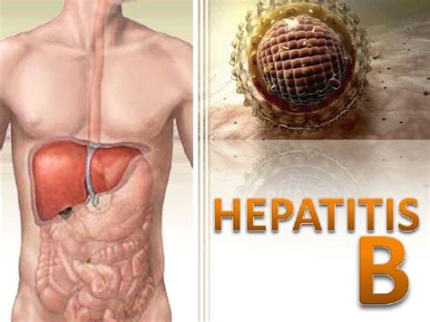 Hepatitis B