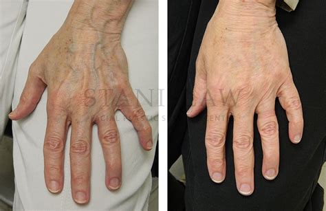 Hand Rejuvenation Gallery 1 Before And After Photos Connecticut