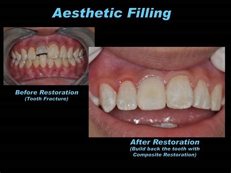 Prestige Dental Care: Aesthetic Filling