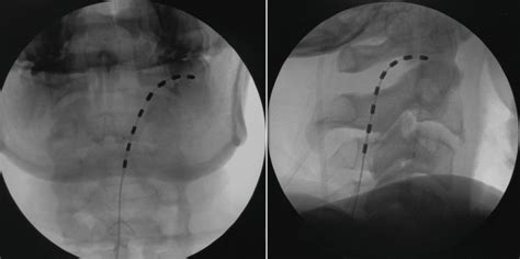 Greater Occipital Nerve Entrapment Springerlink