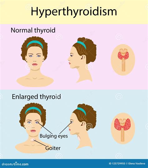 Woman With Enlarged Hyperthyroid Gland Vector Illustration Stock