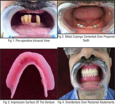 Figure 3 From Tooth Supported Overdenture A Case Semantic Scholar