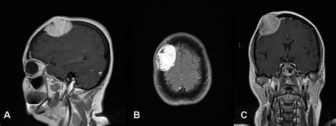Large Osteolytic Skull Tumor Presenting As A Small Subcutaneous Scalp