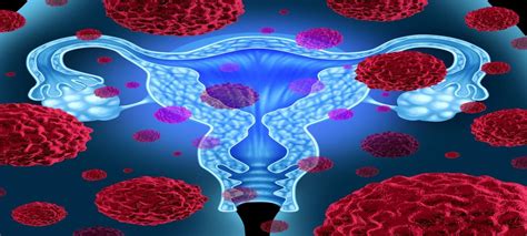Early Detection Test For Ovarian Cancer Qub