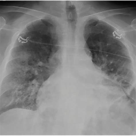 Anteroposterior Chest X Ray Showing New Right Midlung Consolidation And
