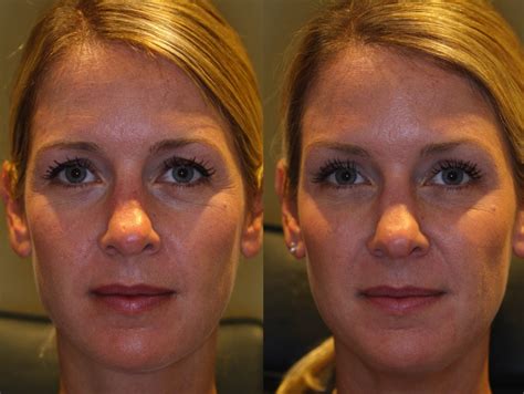 See more ideas about botox brow lift, botox, brow lift. Denver - BOTOX Brow Lift - Photos Show Results Without Surgery