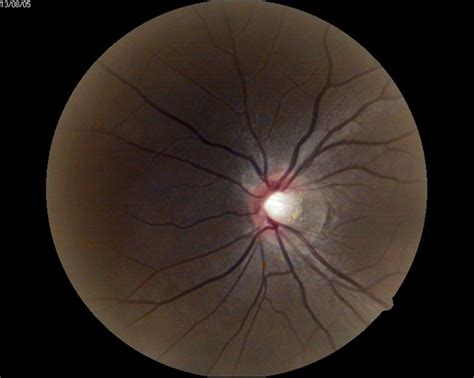 Glaucomatous Optic Atrophy Retina Image Bank