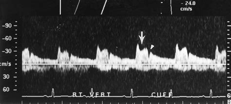 Vertebral Artery Doppler Waveform Changes Indicating Subclavian Steal
