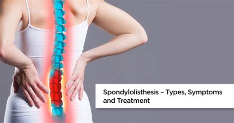 Spondylolisthesis Treatment And Symptoms Of Spondylolisthesis