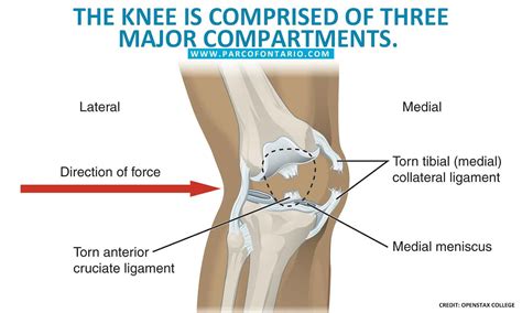 Partial Vs Total Knee Replacement Which Is The Better Option The