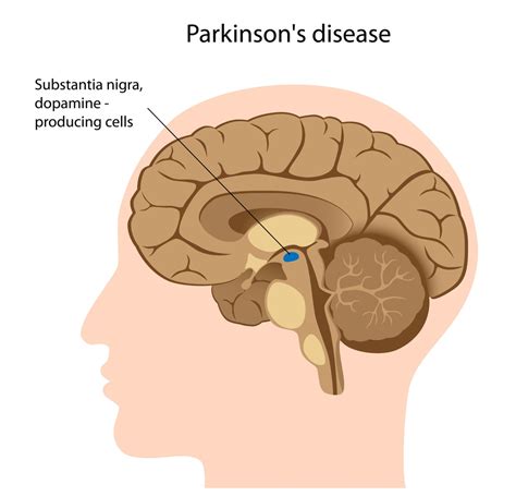 Parkinsons Disease Stemcellreference