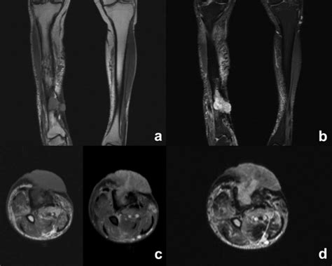 Squamous Cell Carcinoma Of The Right Leg A Cor T1 W Shows Deformity