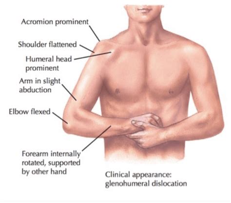 Emdocs Net Emergency Medicine Educationem Am Anterior Shoulder Dislocation Emdocs Net