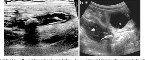 Ultrasound Of The Pediatric Appendix Semantic Scholar