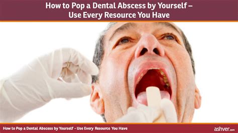 How To Pop A Dental Abscess By Yourself Use Every Resource You Have