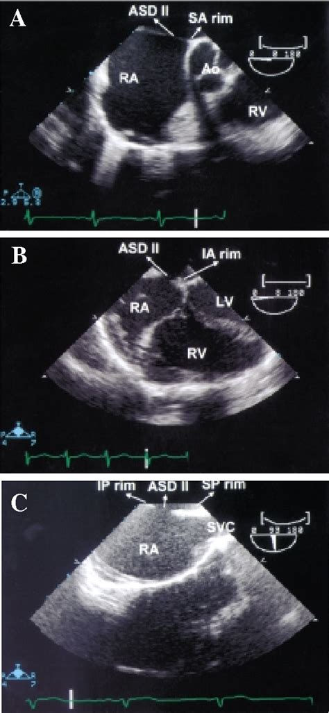 Figure 1 From Usefulness Of Transesophageal Echocardiography For