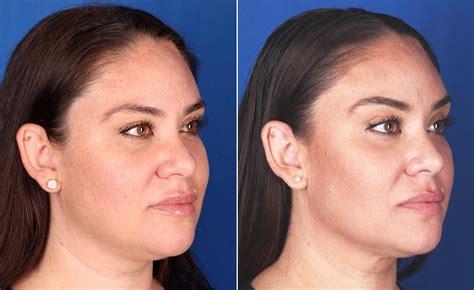 Profound A Non Surgical Treatment For Jawline Neck And Body