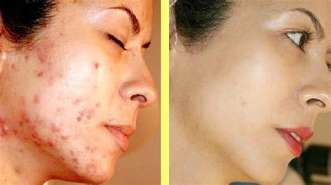 How To Remove Pimples Overnight Acne Treatment Orange Peel Mask