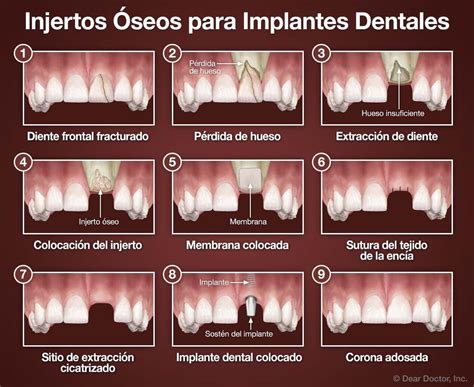 Injertos Óseos para Implantes Dentales Advanced Smiles Dental P A