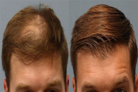Hair Transplant Clinic In Toronto On Fue Canada